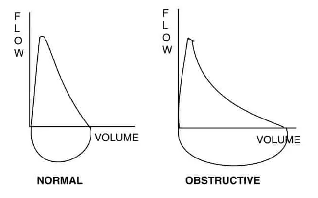 Figure 2. Normal and obstructuve FV loops